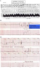 Image result for Delayed Transition from Fetal Circulation