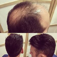 Dans cette sélection pour homme. Le Remplacement De Cheveux Sans Chirurgie Site De En Particulier