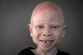 Albino vertebrates exposed to intense light typically lose photoreceptors due to apoptosis.23. Albino Children In Tanzania Targeted By Body Part Hunters The Atlantic
