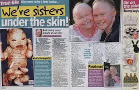 Harlequin ichthyosis, a rare skin disease caused by a mutation of the abca12 gene, requires constant maintenance to harlequin ichthyosis, the rare condition that leaves sufferers mistaken for dolls. Harlequins Disease Nicola Fahey
