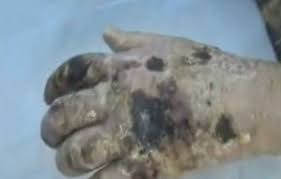 KROKODIL - THE 'POOR MAN'S HEROIN' - GRAPHIC IMAGES