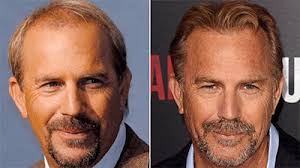 Celebrity Hair Transplants: 14 Most Unexpected Transformation