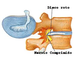 Resultado de imagen de hernia discal