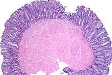 Are you or a loved one suffering from mesothelioma? Leiomyoma Wikipedia