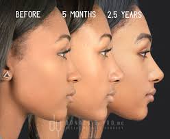 Pin On Rhinoplasty Before And After