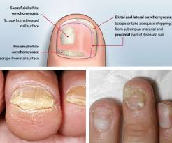 Nail fungus can cause the nail to become thick or ragged and appear yellow, green, brown or black. These Types Of Infections Can Occur On Both The Toenails And The Nails On The Hand Typically The Nail Toenail Fungus Toe Fungus Toenail Fungus Essential Oils