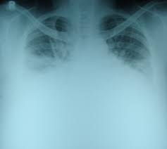 In healthy lungs, these membranes ensure that a small amount of liquid is present between the lungs. X Ray Chest Pa View In Heart Failure