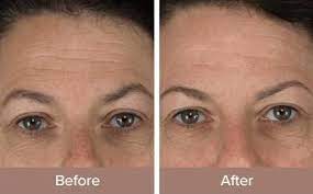 The trophy skin microderm md pays for itself after just a couple of uses. Microdermmd Microdermabrasion Microdermabrasion Machine Microdermabrasion Treatment