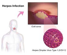 There are several different types of herpes. Herpes Simplex Wikipedia