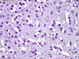 Image result for Chondrosarcoma