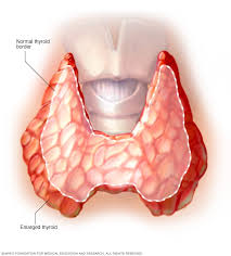 The disease occurs more often in women than in men, which may be related to hormonal factors. Graves Disease Symptoms And Causes Mayo Clinic