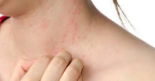 Maybe you would like to learn more about one of these? Should I Look For Hives As A Sign Of The Flu Passport Health