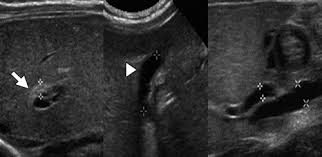 Usually, the presence of jaundice after the child is 3 weeks old might indicate some. Biliary Atresia Color Doppler Us Findings In Neonates And Infants Radiology