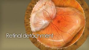 Retinal Detachment Causes Treatments News And Surgery Detachment Eye Health Vision Loss