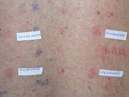 Because sunscreen has become so prevalent in our society, so have sunscreen allergies. Sunscreen Allergy Dermnet Nz