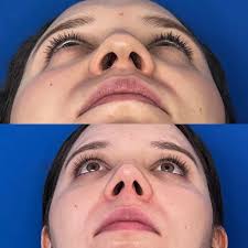 El botox siempre es nuestro...