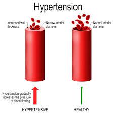 Reduce High Blood Pressure With Plates, Forks, And Exercise - Drcarney.com  Blog - Drcarney.com