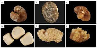 Image result for Calcium Nephrolithiasis