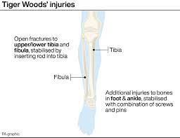 Tiger woods suffered significant leg injuries after a crash near los angeles. Tiger Woods At Beginning Of Long Road To Recovery Leading Surgeon Bill Ribbans Golf365