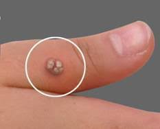 When your dermatologist uses cantharidin (beetle juice) to treat molluscum, you need to wash it off at home with soap and water to prevent a serious skin irritation. Molluscum Contagiosum Aventura Fl Cantharone Warts Treatment Aventura Fl
