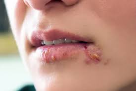 Image result for oral herpes symptoms roof of the mouth