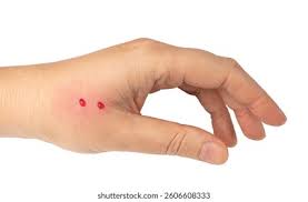 Image result for Human Bite