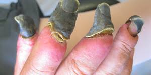 Gangrena — tana yoki a'zo qismlarining o'lishi (nekrozi) hisoblanib, bunda zararlangan quruq gangrenani dastlabki bosqichlarda nisbatan xavfli va og'ir bo'lgan nam shaklga o'tishini oldini olish. Gangrena Sintomas Causas Y Tratamientos