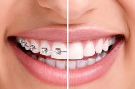 The braces should help straighten out your front teeth. Orthodontic Instruments Supplies Henry Schein Dental