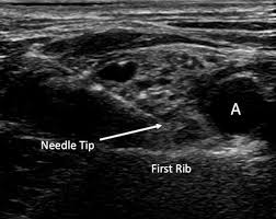 Image result for Superior Trunk Block