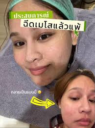 แชร์ประสบการณ์แพ้เมโส: สิ่งที่ต้องระวังก่อนฉีด