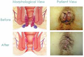 Get Rid Of External Hemorrhoids Without Surgery 