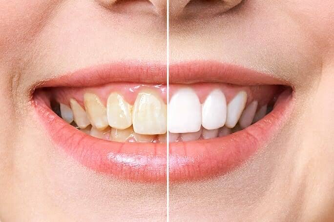 Teeth Whitening treatment product image