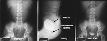 Image result for Voiding Cystourethrogram