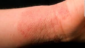 A Possible New Weapon Against Eczema Live Bacteria How do dermatologists diagnose dyshidrotic eczema? weapon against eczema live bacteria