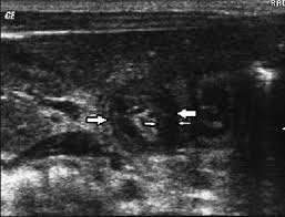 A normal mode occurs when all parts of a system oscillate with the same frequency. Target Sign On Transverse Sonogram Of Hypertrophic Pyloric Stenosis In Download Scientific Diagram