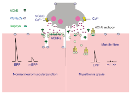 Myasthenia gravis is the most common disorder of the neuromuscular junction. Pathogenesis Of Myasthenia Gravis Update On F1000research