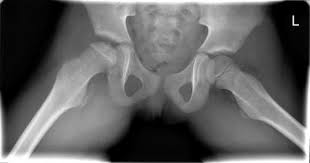 Image result for Pediatric Limp