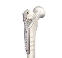 Locking Trochanter Stabilization Plate
