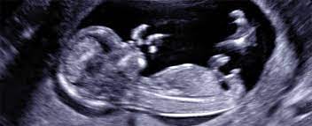 Schwangerschaftswoche mittels einer besonderen sonografischen methode beziehungsweise eines feinultraschalls ein detailliertes organscreening des ungeborenen vorgenommen wird. Fruhe Feindiagnostik Nt Messung 12 Ssw Frauenarztinnen Gemeinschaftspraxis Berlin Schoneberg