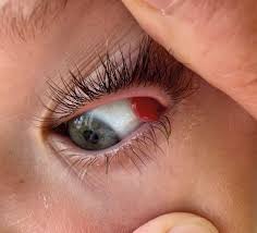 Image result for Eye Foreign Body