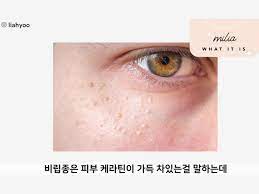 Cara menghilangkan jerawat secara alami menggunakan tea tree oil. Perbedaan Whitehead Milia Dan Fungal Acne Serta Cara Mengatasinya Menurut Liah Yoo Beauty Journal