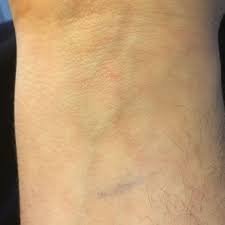 Sepsis is a serious medical condition. Lymphangitis Roter Strich Sepsis