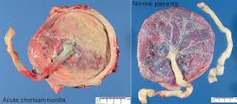 Image result for Chorioamnionitis