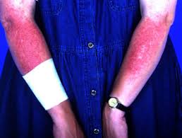 You can be allergic to sunscreen, causing an itchy, red reaction. Sunscreen Allergy Dermnet Nz