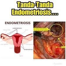 Masuk semula bilik bedah untuk buang rahim. Jom Usaha Hamil Penyakit Endometriosis Semakin Meningkat Dan Merosakkan Peranakkan Wanita Menimbulkan Masalah Kesuburan Dan Kemandulan Keguguran Dan Akhirnya Bedah Buang Rahim Tanda Tanda Endometriosis Berikut 1 Senggugut Yang Semakin Teruk