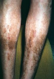 Image result for Pigment stains on the shin