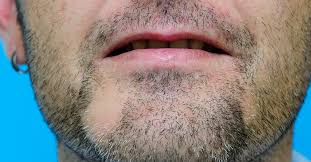 Vitiligo is a medical condition in which due to. Alopecia Barbae Causes Symptoms And Treatments
