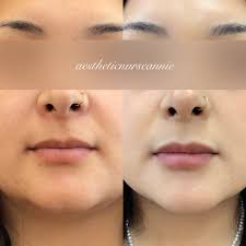 Fresh off the needle! My stunning client after 1 syringe of Juvederm Voluma  in her chin 😍 Her goal was facial balance, and we were able to achieve  that by elongating the