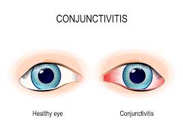 Image result for Allergic Conjunctivitis