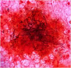 A Rare Case Of Brain Abscess Caused By Actinomyces Meyeri Bmc Infectious Diseases Full Text